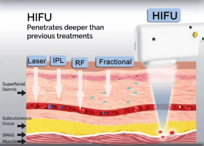 HIFU treatment penetration levels compared to laser, IPL, RF, and fractional treatments