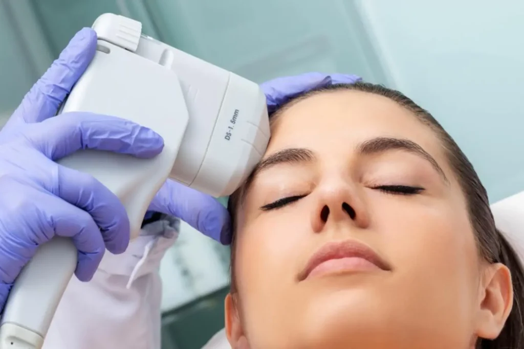 HIFU treatment on forehead, skin tightening and rejuvenation in clinic setting