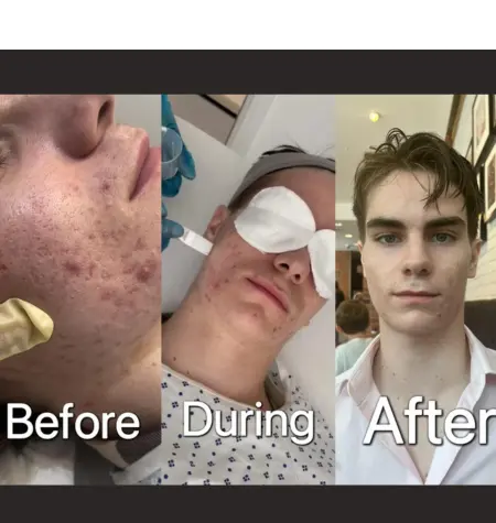 Before, during, and after chemical peel treatment showing skin improvements at Vita Renewal Aesthetics