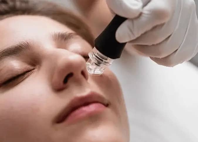 Close-up of a woman receiving a microneedling treatment with a specialized device