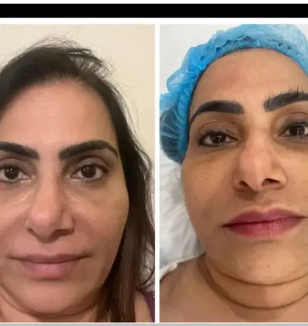 Hifu result Before and after