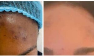 Before and after results of hyperpigmentation treatment on the forehead by Vital Renewal Aesthetics