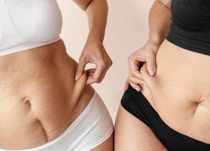 HIFU body contouring treatment showing fat reduction on the abdomen