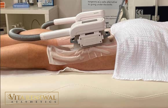 Cryolipolysis fat freezing treatment in Knightsbridge London