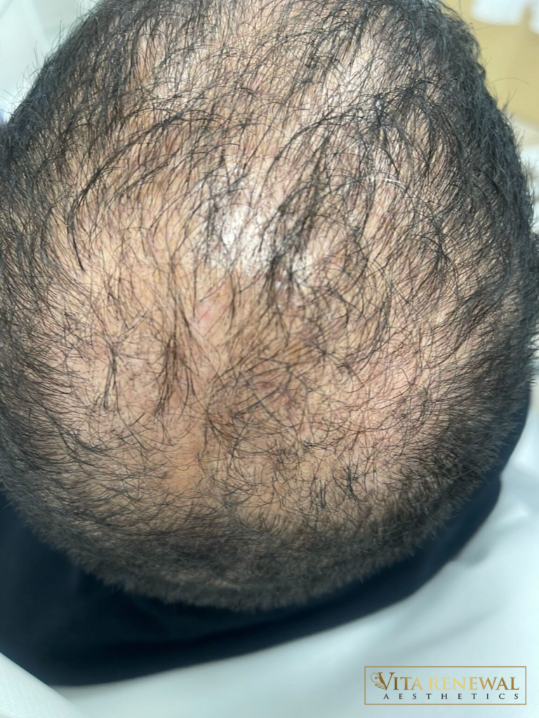 Scalp showing thinning hair following previous hair transplant, supported with PRP and PRF treatments