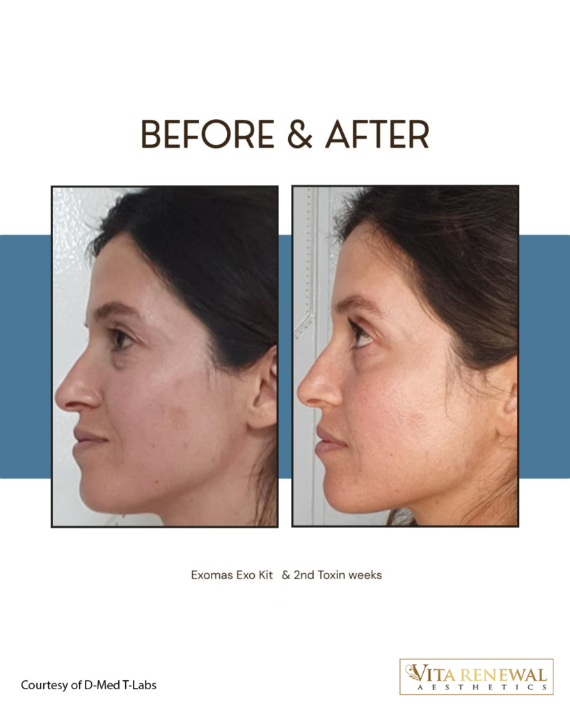 Advanced PRP (Exosomes)