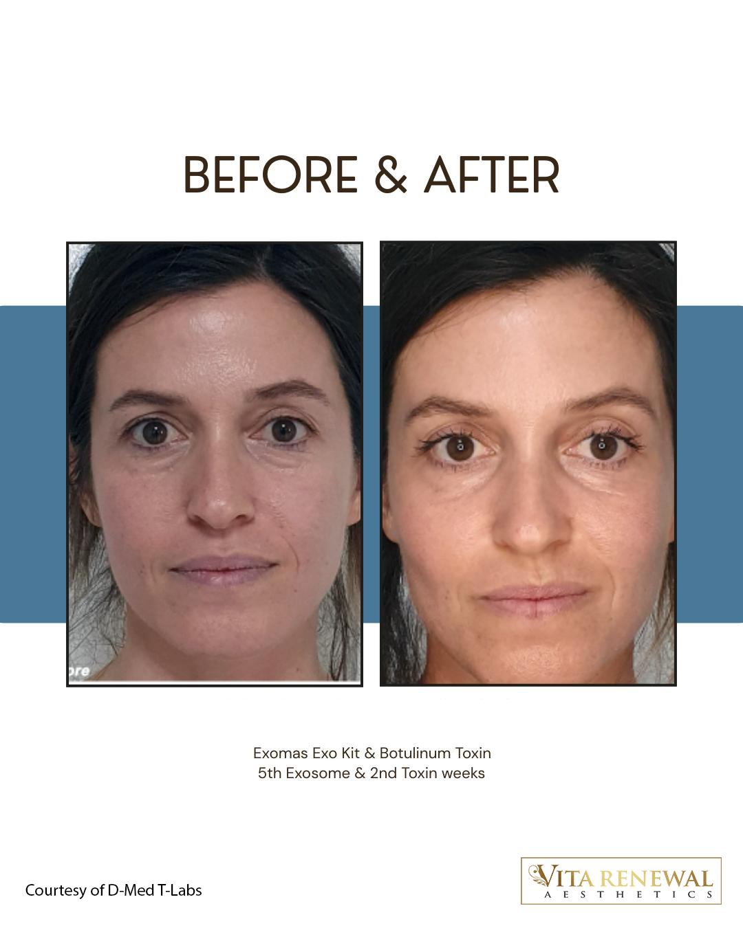 Before and after results following Exomas Exo Kit, botulinum toxin and advanced PRP facial treatment.