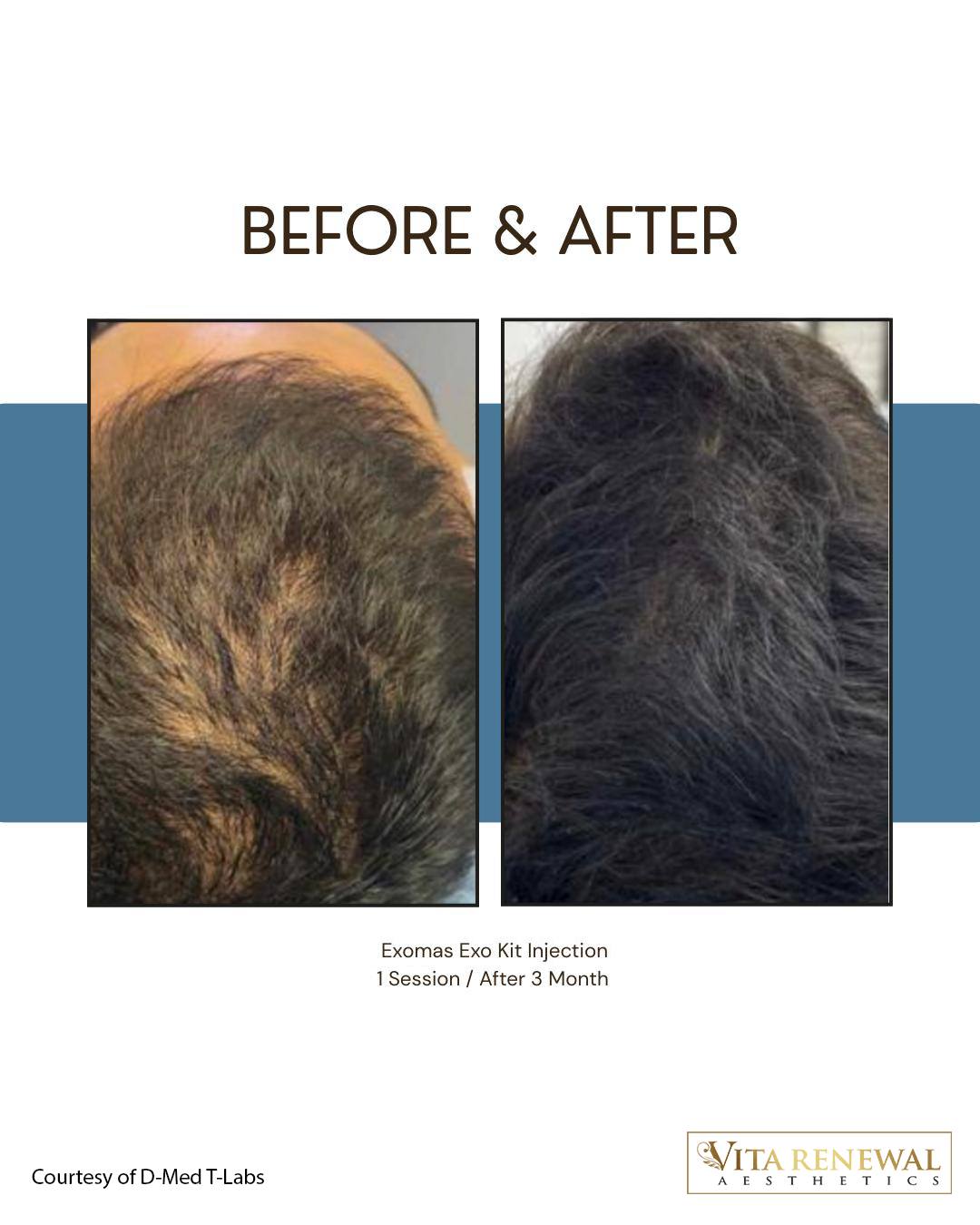 Before-and-after scalp comparison showing improved hair density following an Exomine exosome injection treatment.