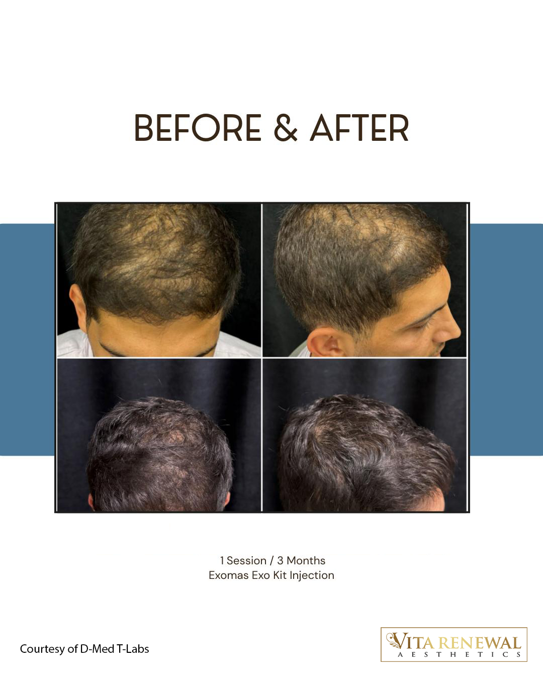 Before-and-after scalp images showing improved hair density three months after one Exomine exosome treatment session.