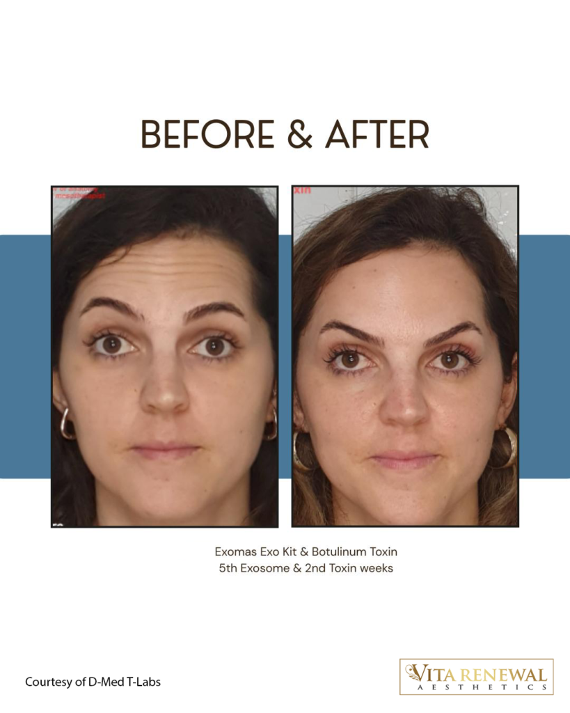 Regenerative Medicine in Knightsbridge Before-and-after facial treatment results using Exomas Exo Kit and botulinum toxin over two weeks.