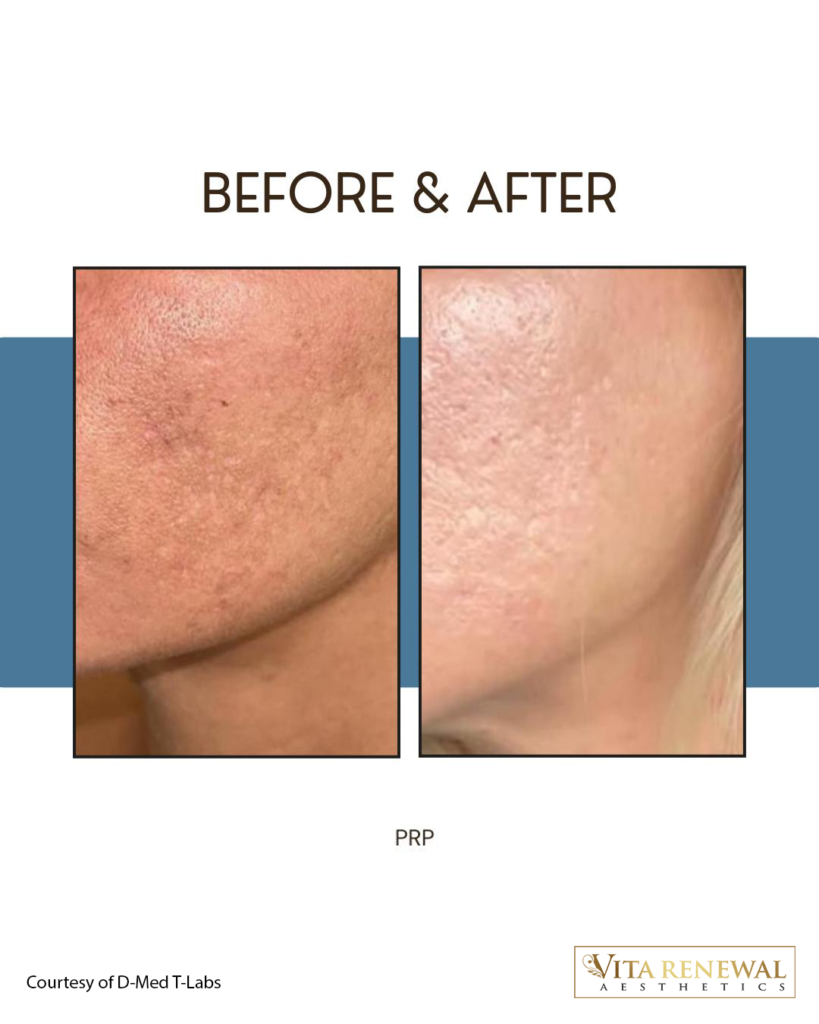 Before-and-after cheek images showing smoother and more even-looking skin following PRP treatment