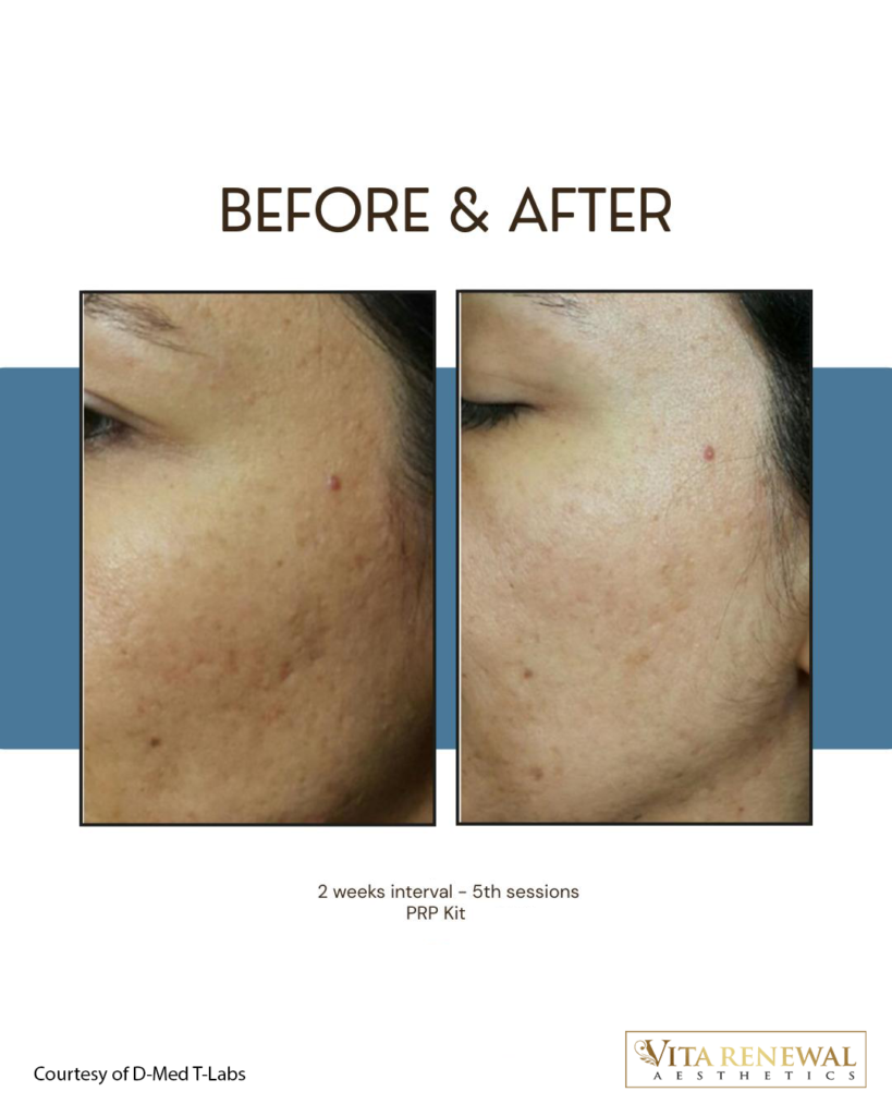 Before-and-after facial images showing improved skin texture following five PRP treatment sessions