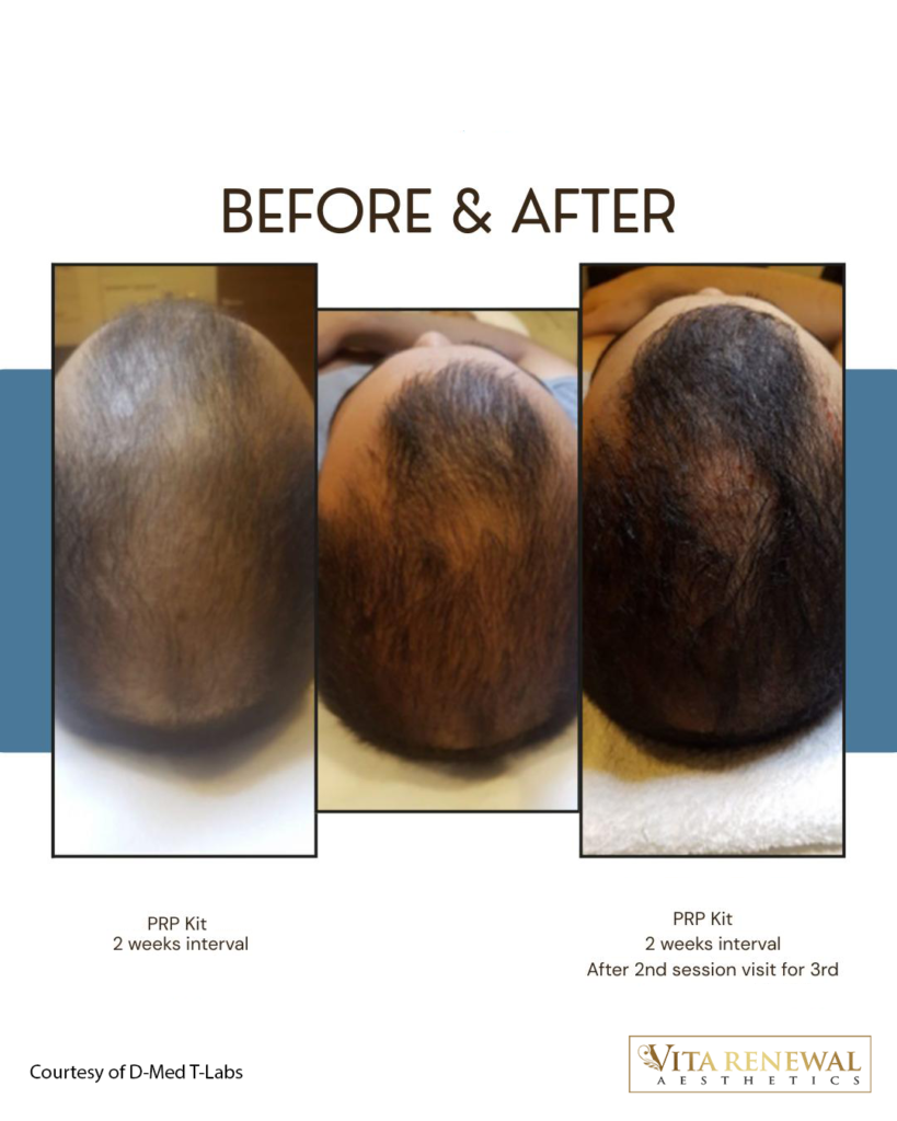 Before-and-after scalp images showing improved hair coverage following PRP treatment