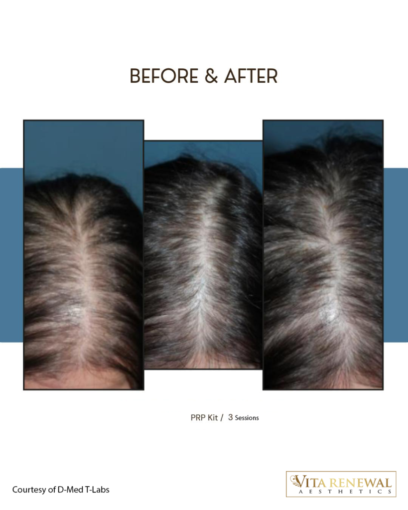 Before-and-after scalp images showing hair changes following three PRP treatment sessions