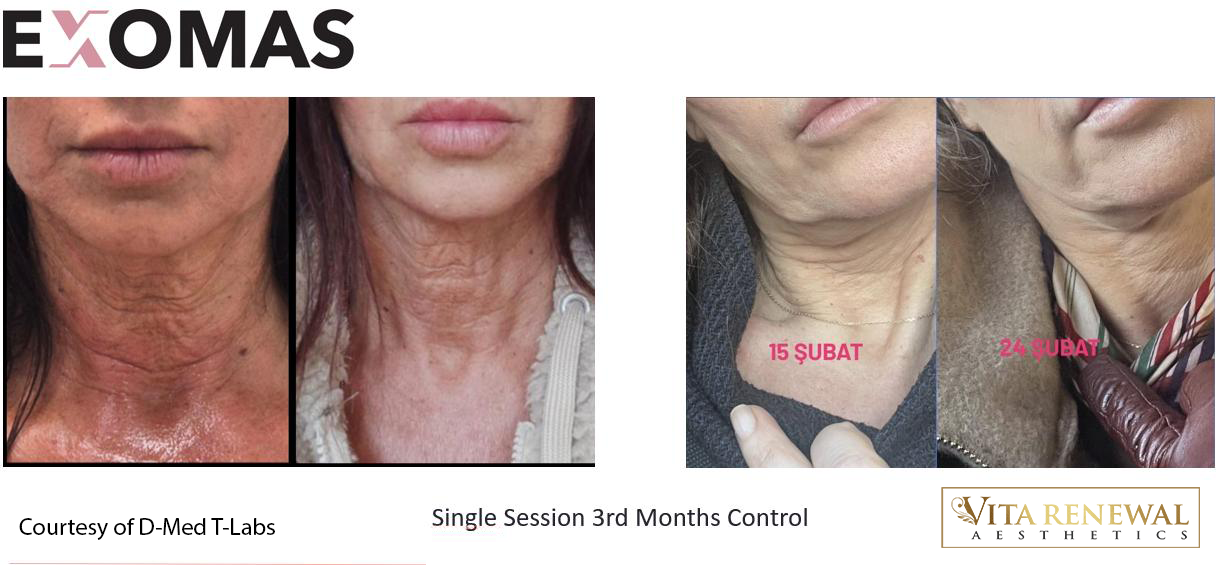 Before-and-after comparison showing neck and lower-face improvement three months after one Advanced PRP treatment.